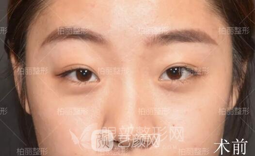 开眼角多久恢复 真人案例分享