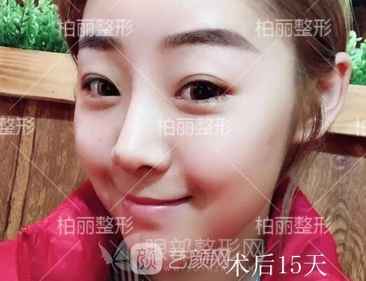 开眼角多久恢复 术后15天果分享