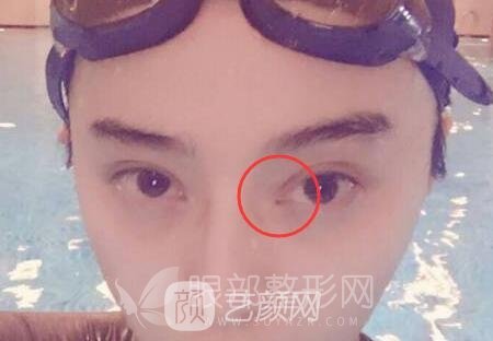 开眼角手术明星也爱