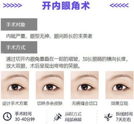 开内眼角手术怎么做