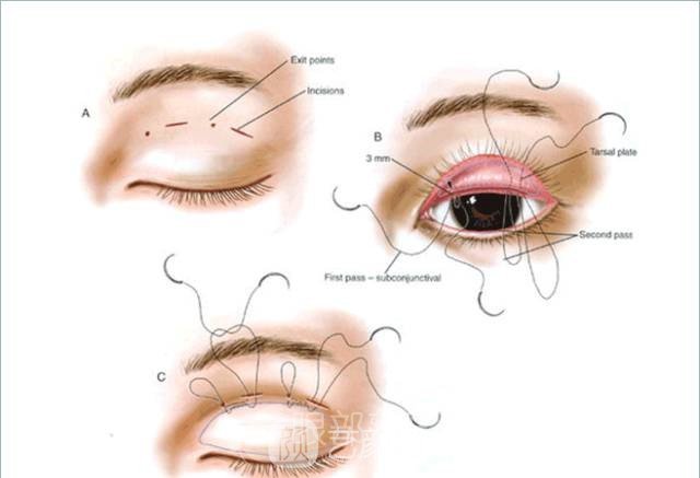 高分子双眼皮轻松让你变成女神，成为人群中较靓的那一个！