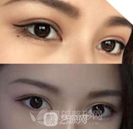 北京做双眼皮手术哪里好 多少钱