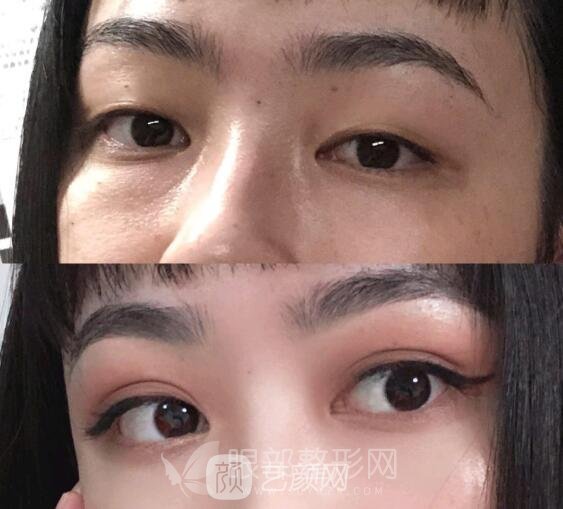 北京做双眼皮手术果好不好 案例