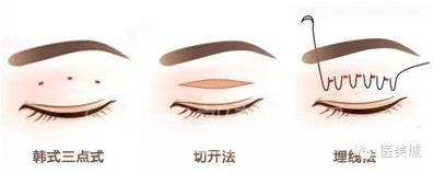 北京做双眼皮手术要多少钱