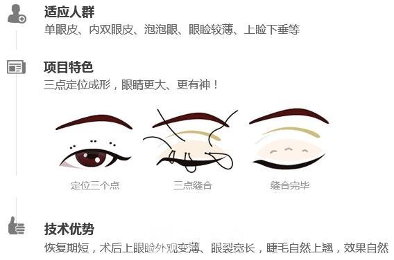 韩式三点定位双眼皮手术原理简介