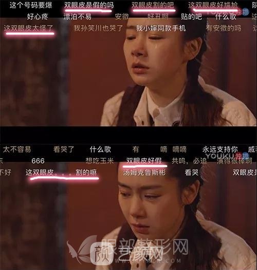 做双眼皮哪种方式好