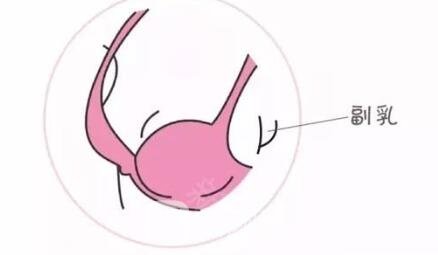 四个姿势改进隐匿性副乳~