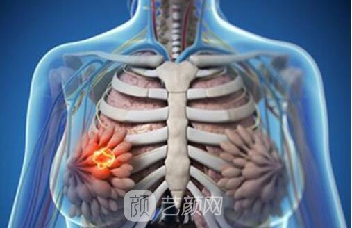 乳腺结节良性和恶性的区别