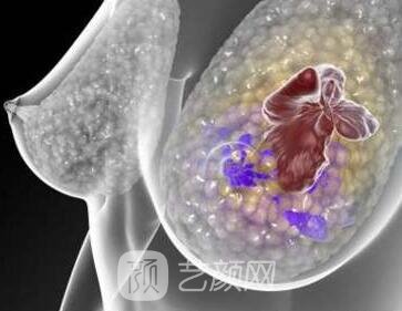 乳腺结节良性和恶性的区别