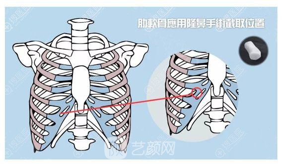 取肋软骨材料位置示意图