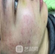 杭州维多利亚整形医院去疤怎么样？案例及价格一览