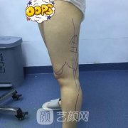 北京禾美嘉任伟民大腿吸