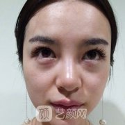 广州健丽医美去眼袋案例