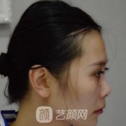 东莞星采整形医院膨体隆