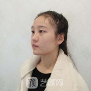 素美杨迪双眼皮失败修复