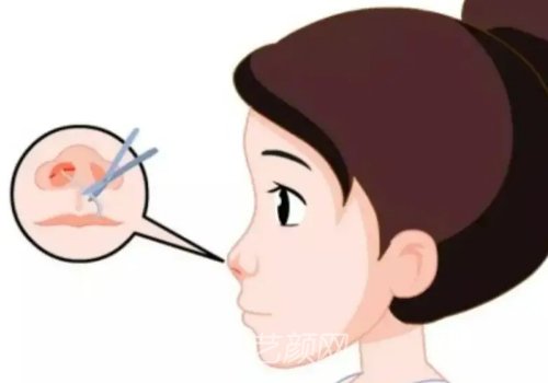 李健做鼻子效果图一览|医