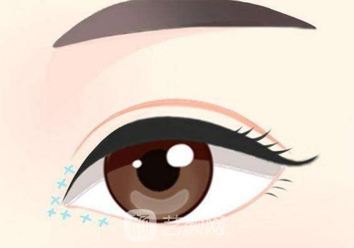 长春中妍整形医院做双眼