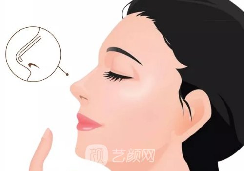 骨雕鼻可以维持多久?一般