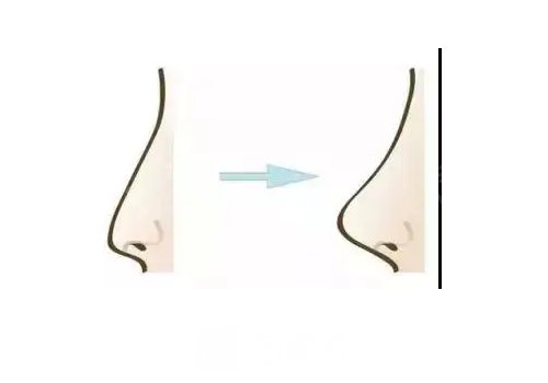 少女针填充鼻子什么时候