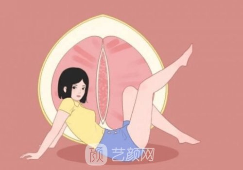 菲蜜丽激光紧缩恢复期多