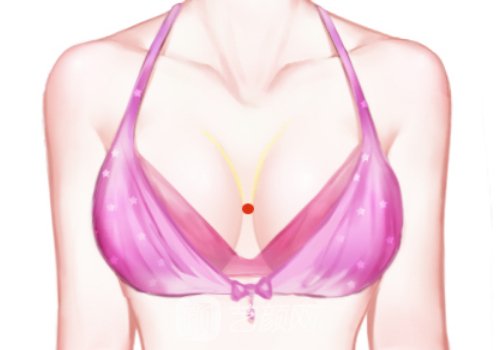 人工韧带乳房提升有效果