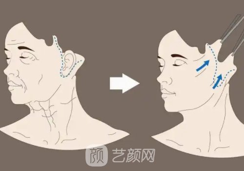 维维提升手术是做什么的