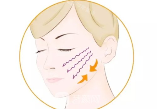 双矢量提升术恢复期多久