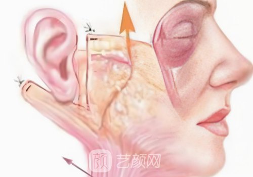 双矢量提升术与拉皮有什