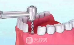 奥齿泰种植牙价格多少钱