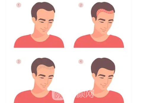 重庆种植头发多少一个毛