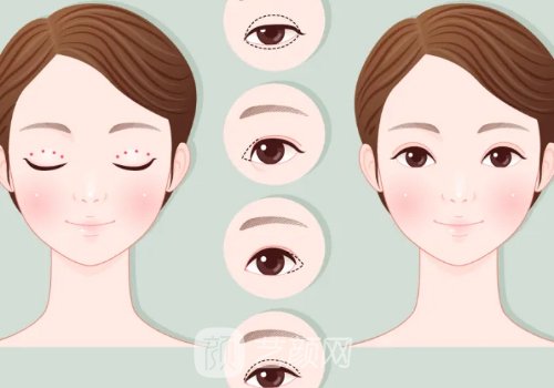 武凤莲做双眼皮案例图片