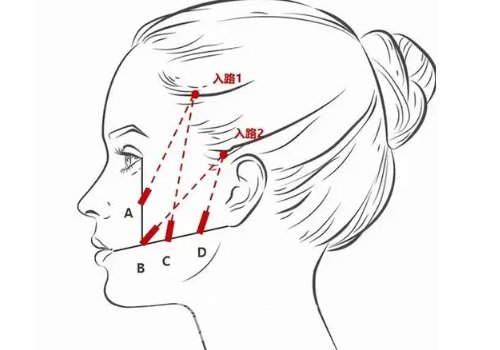 医美轮廓固定多少钱?参考