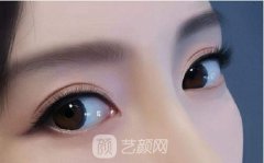割双眼皮内眼角分叉修复
