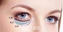 内切眼袋恢复期要多久？
