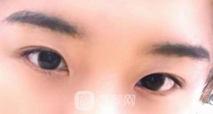 眼睛蒙古褶怎么消除？蒙