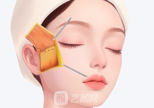 童颜微提3.0多少钱?价格及