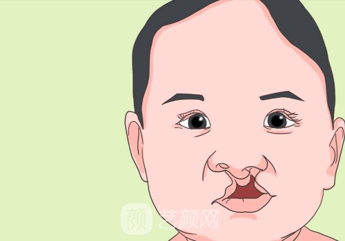 兔唇免费修复的条件是什