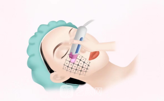 金达威聚拉美超声刀效果