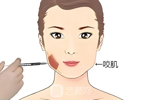伊婉致柔玻尿酸适合打哪