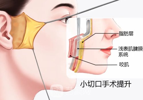 丁昆琨拉皮复位怎么样?技