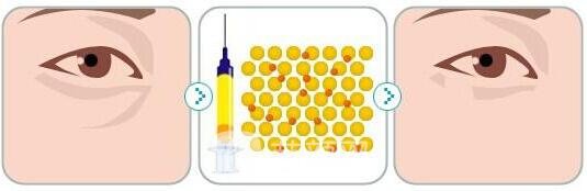 胶原蛋白填充泪沟